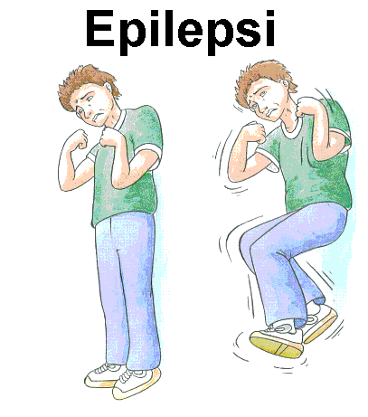 Kejang Infantil - Obat Alami Untuk Epilepsi yang parah